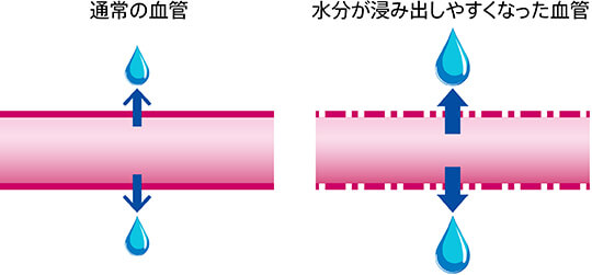 血管性浮腫の原因となる血管の変化