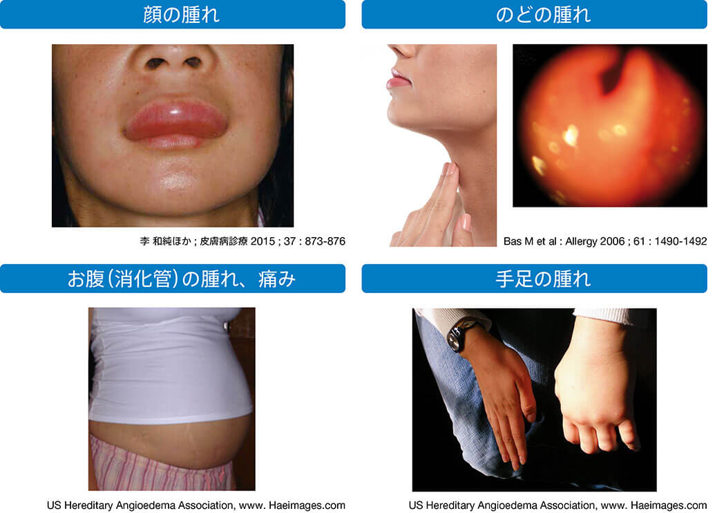図3 日本人HAE患者における発作の頻度
