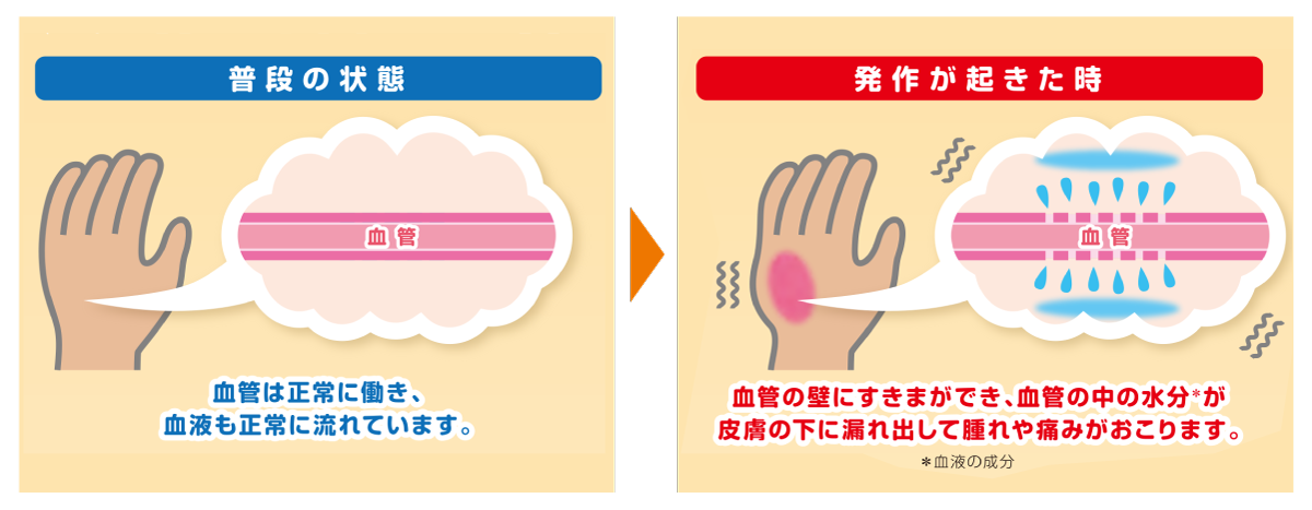 発作の原因は血管からの水漏れだからです