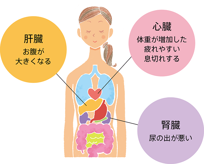 全身性で、指で押すとへこんでしばらく元にもどらないむくみの代表例